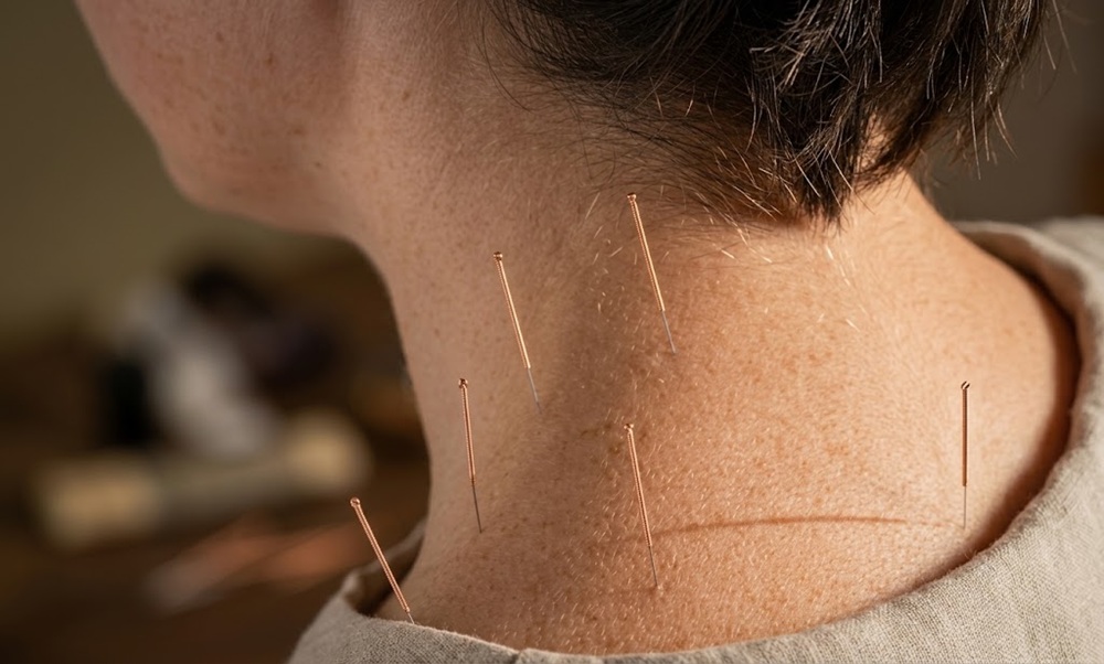 dry needling can help reduce myofascial pain