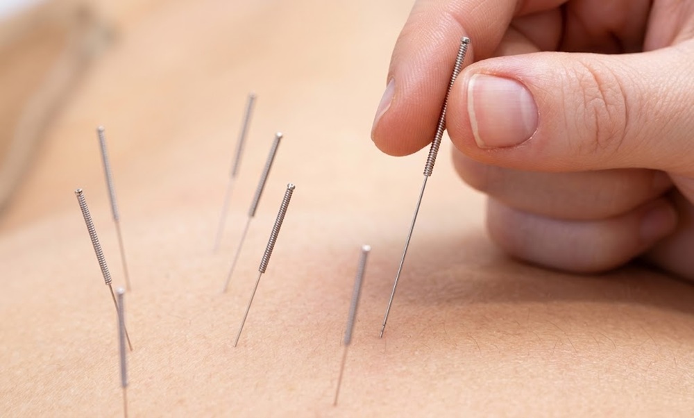 Dry needling involves inserting a thin, solid needle into specific areas 