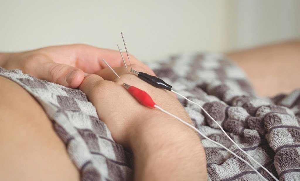 Dry needling treatment for muscle pain