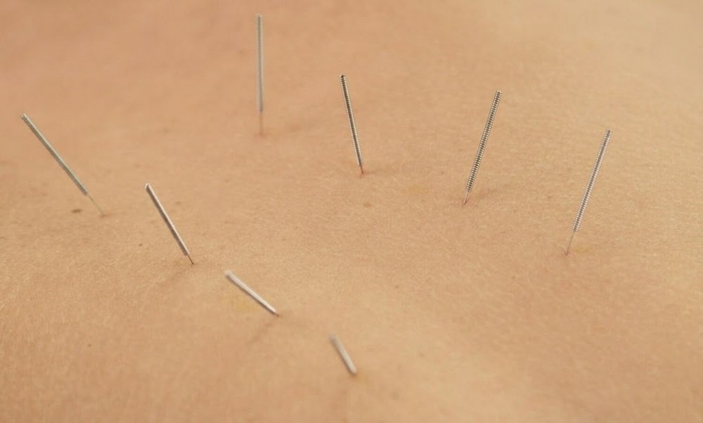 Side Effects of Dry Needling?