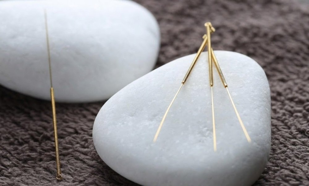 Dry needling treatment performed by a physical therapist