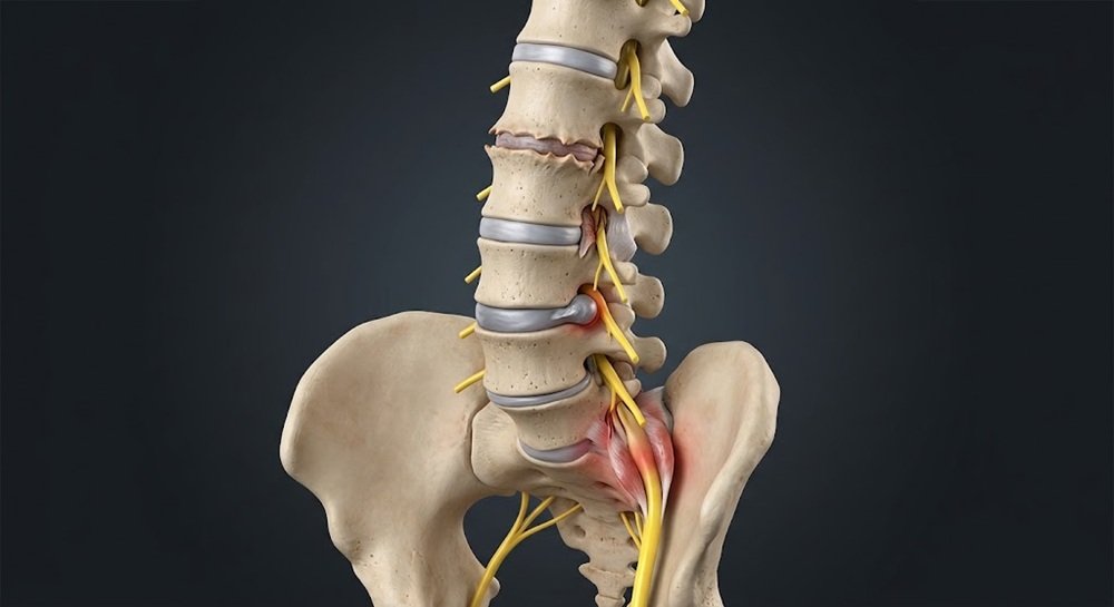 Sciatica Pain Feel Like