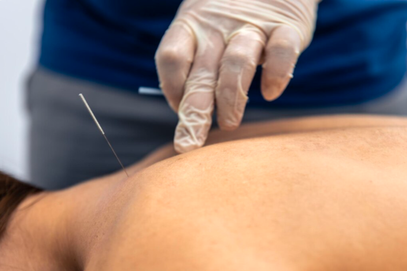 Physiotherapist performing dry needling for muscle tension.