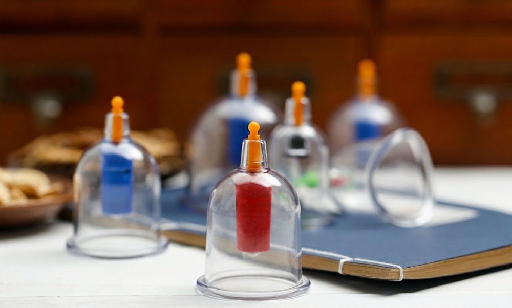 Cupping Therapy Used in Physiotherapy