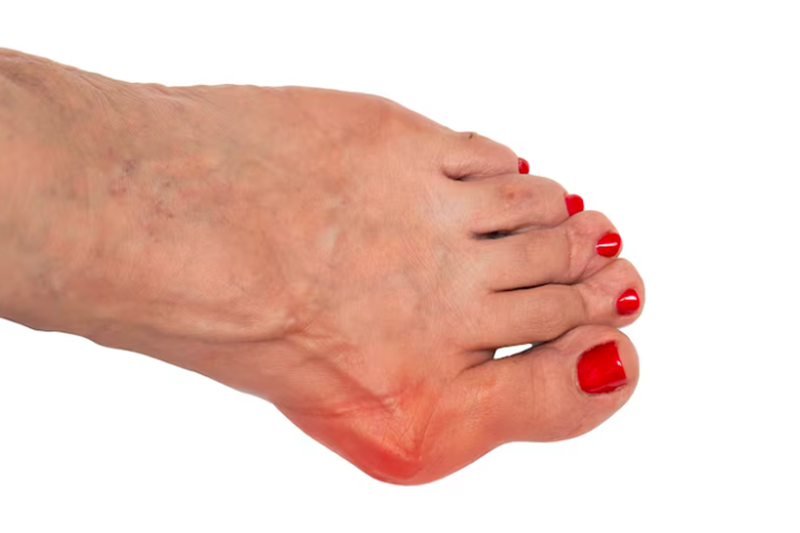 Can Bunions Be Corrected Without Surgery?