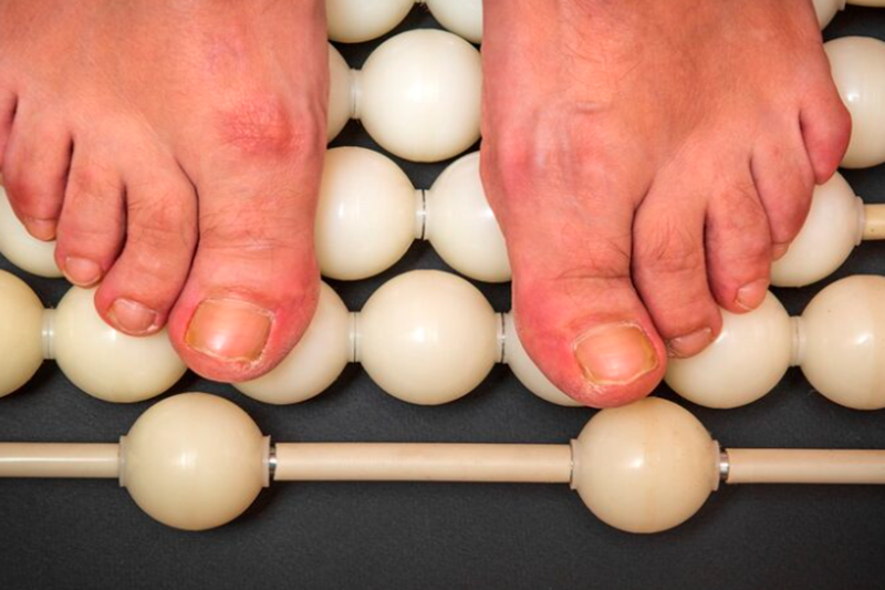 Can Bunions Be Prevented?