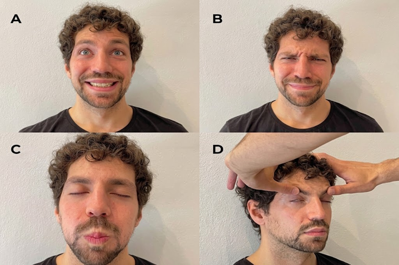 Bell’s palsy early facial rehabilitation