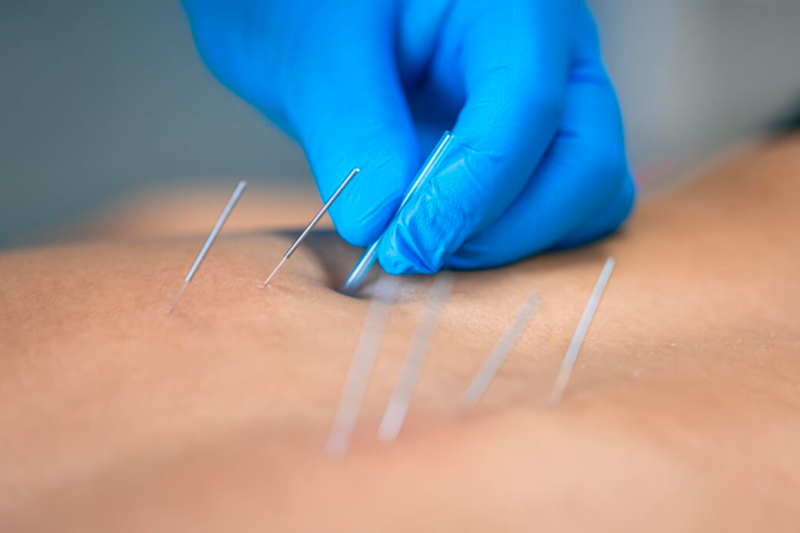Dry Needling